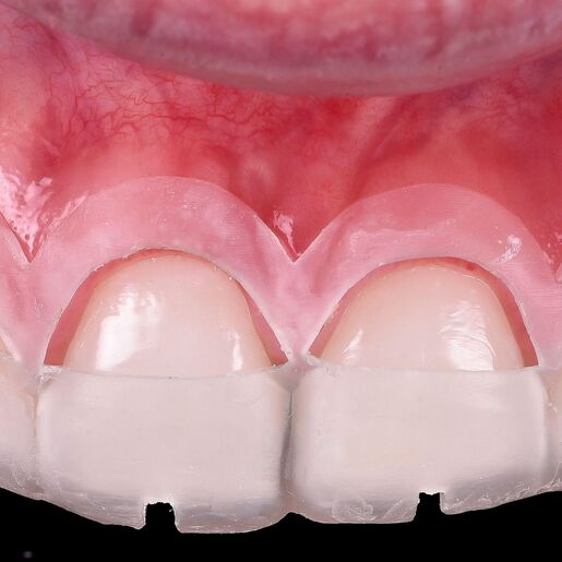 Crown lengthening2 new