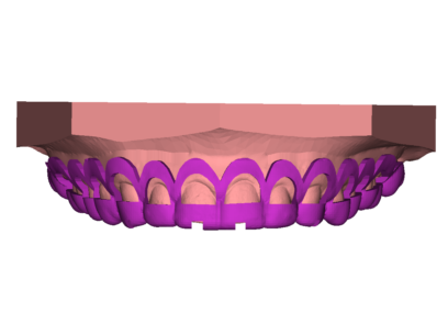 Crown Lengthening Guide