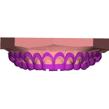 Crown Lengthening Guide