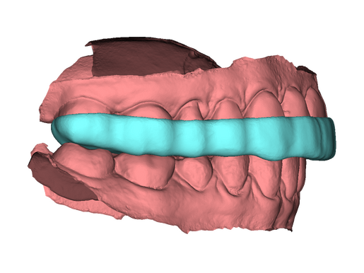 DSD Bite Splint Design