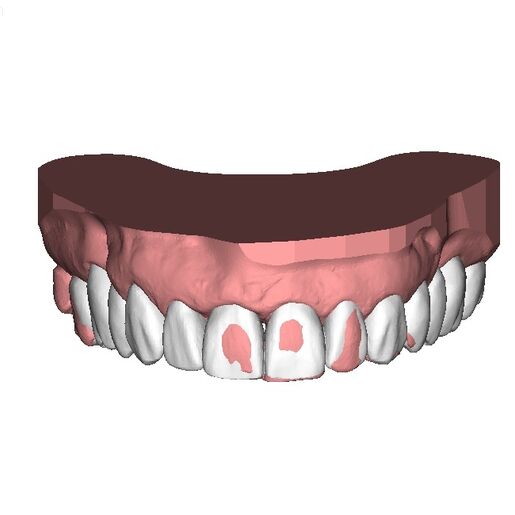 DSD Reduction Guides Design 2